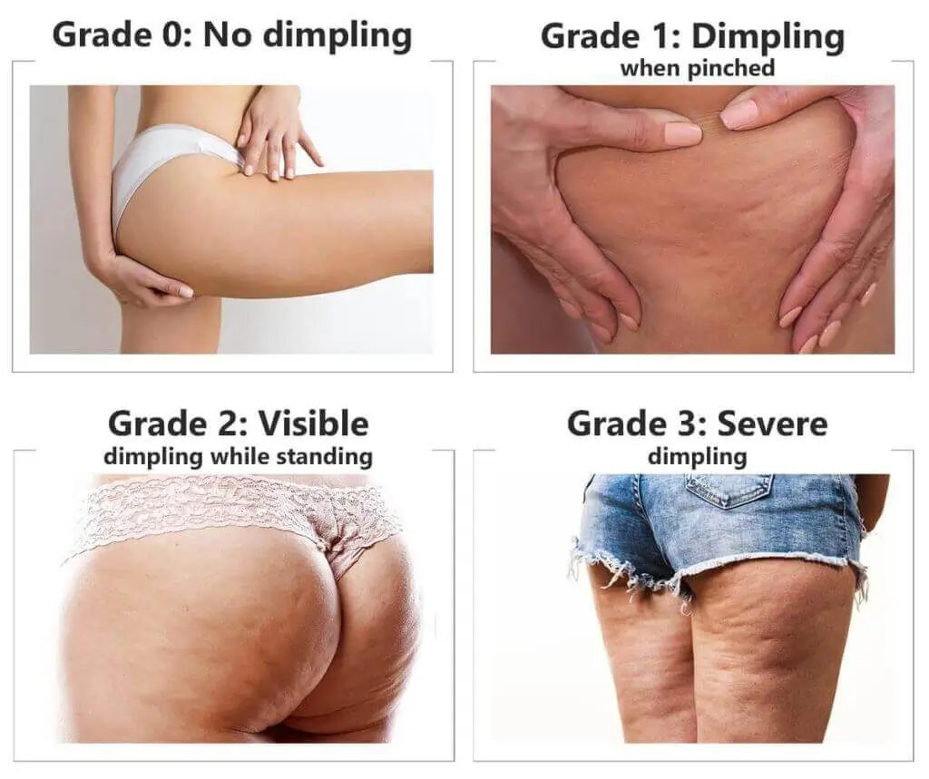 Representation of the stages of cellulite development Virginia Water