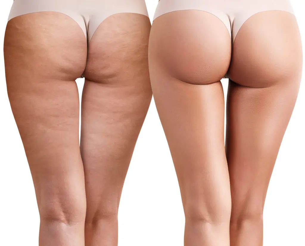 Read about cellulite Virginia Water: causes, treatments, and debunked myths